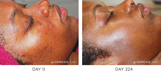 Osmosis pigmentation before and after, day 0 and day 224