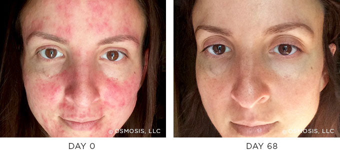 Osmosis redness before and after, day 0 and day 68