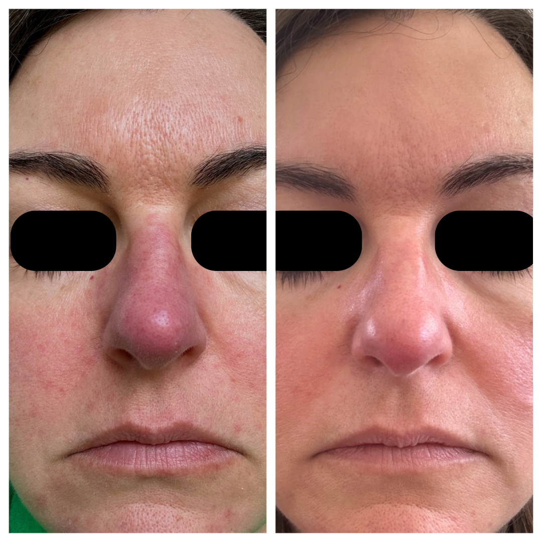Before and after results following a digestive cleanse
